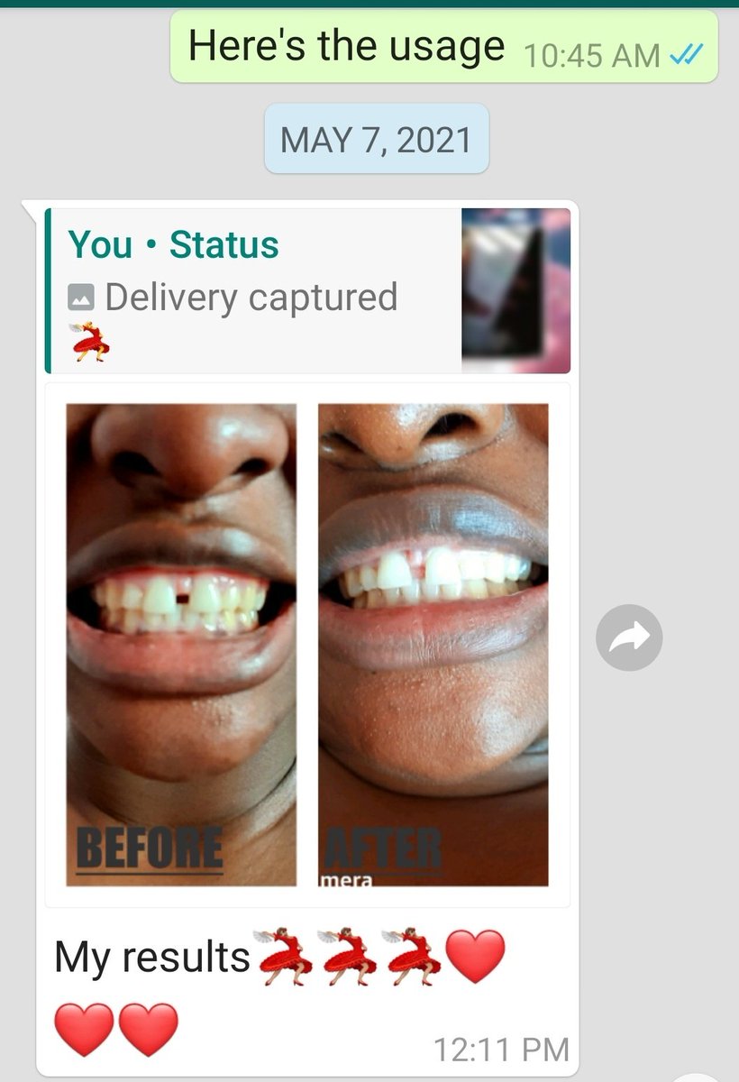 RadiantBeauty19's tweet photo. Yellow, stained teeth??

Try ap24 Whitening Toothpaste that remove stains to help your teeth return to their natural colour 👌🏾

📲 Whatsapp 0795561274 or DM 

#Amakhosi4Life Chiefs #TheWayNgingakhona Mahlatsi Sekhukhune #PhoneAssemblief https://t.co/KkzpBOWU5g
