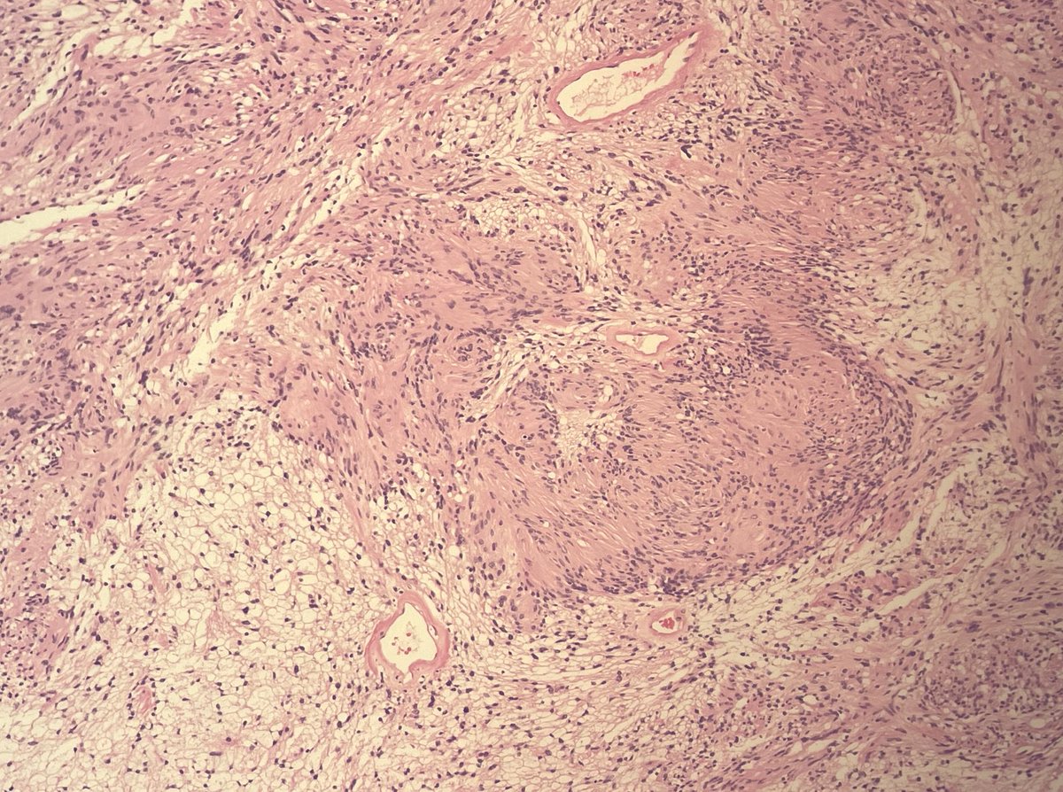 Case presentation. A 59 yo woman with a 3x2 cm nodule in the right leg. Dx. Schwannoma. Beatiful Verocay Bodies. #Pathresidents #PathTwitter #Pathology #softtissue #tumors