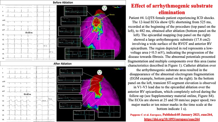 📌 High-risk LQTS 👉 Cath. ablation of RV epicardium electroanatomical abnormalities as a novel approach to successfully prevent malignant VA recurrences #EPeeps #CardioTwitter @DrRoderickTung @DrJasonAndrade @LuigiDiBiaseMD @DrFerminGarcia @DhirajGuptaBHRS @tomdepotter @ftrae