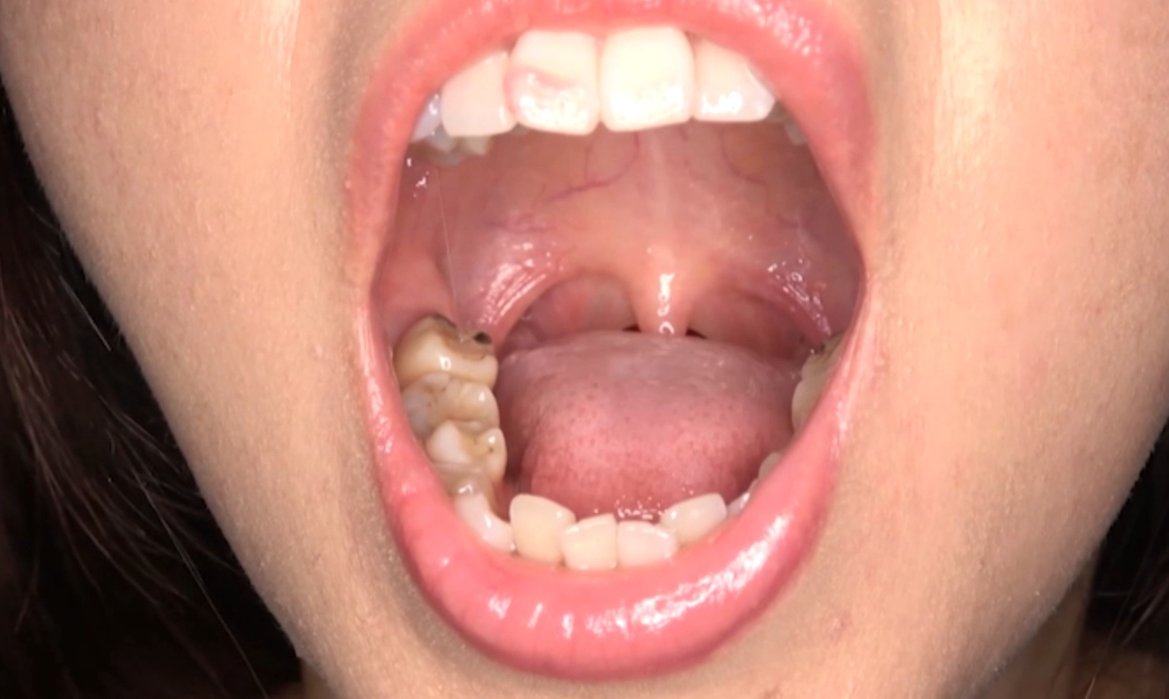 teeth_fetch's tweet photo. 可愛いのに口内が汚くて興奮しました

う蝕やCRの着色だけでなく、前歯部は破折して再着した歯なのかな？真ん中から折れてる💦

https://t.co/HvTQAz2UaD

#口内フェチ #口腔フェチ #歯フェチ #銀歯フェチ #歯科治療 #舌フェチ https://t.co/tvpT5GYkXj
