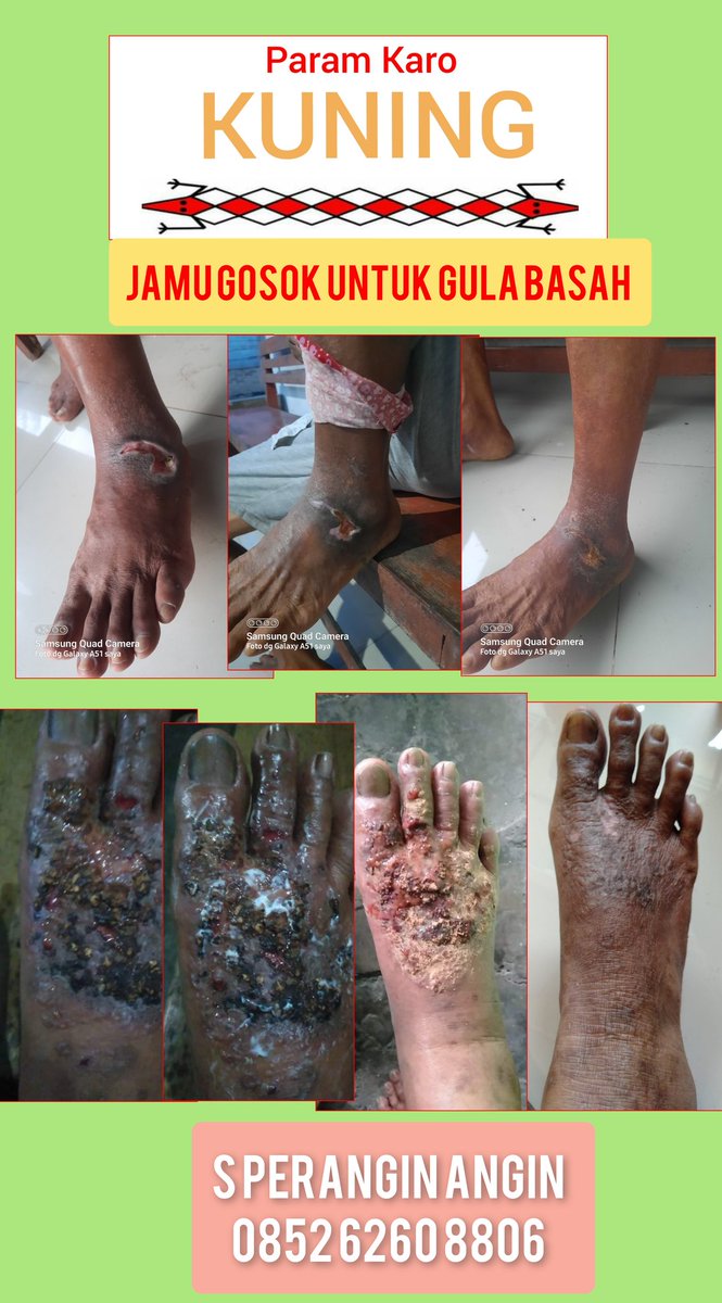 petrusperangin's tweet photo. GULA BASAH CEPAT SEMBUH DENGAN https://t.co/S3lJZEI5Ty https://t.co/0yCcPM9vko