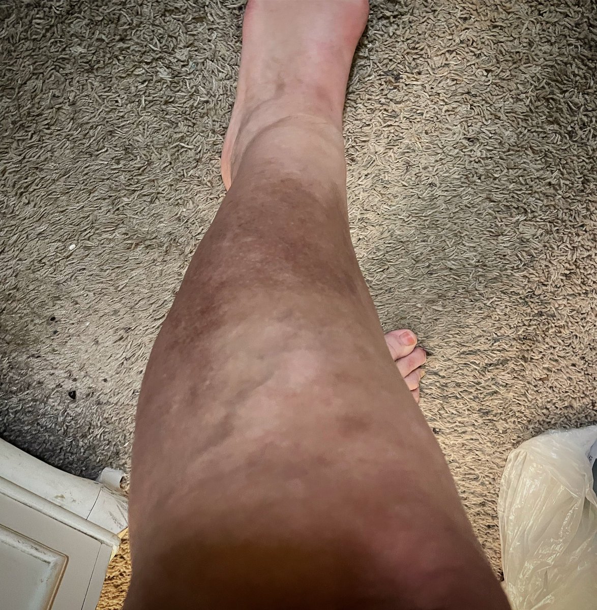 GinnylovesMaui's tweet photo. 8 months post fall and cellulitis infection and it still looks like this. 🤦🏼‍♀️Wondering if this ever go back to normal. #dontfalldown https://t.co/p1DodOBm5z