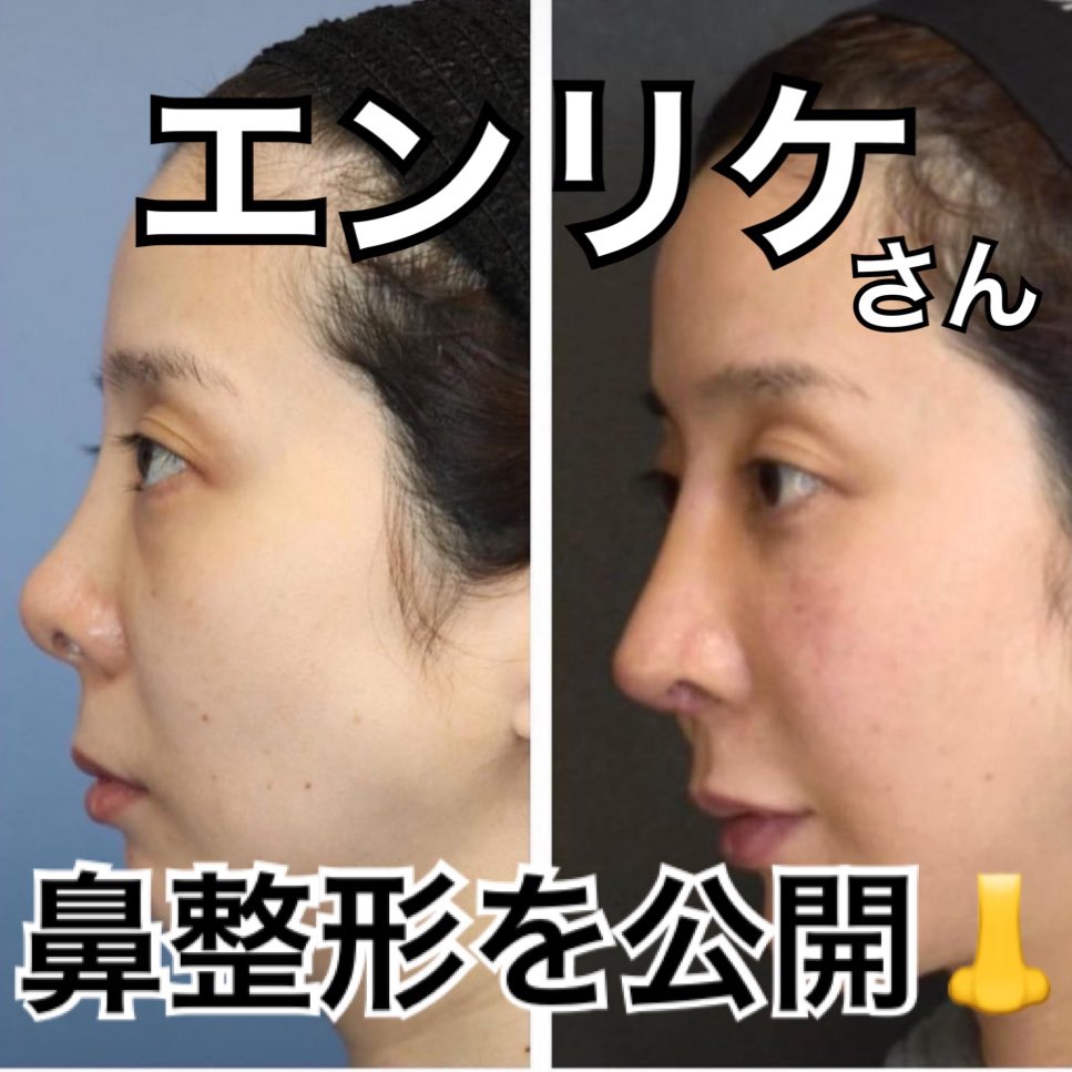 エンリケ 整形