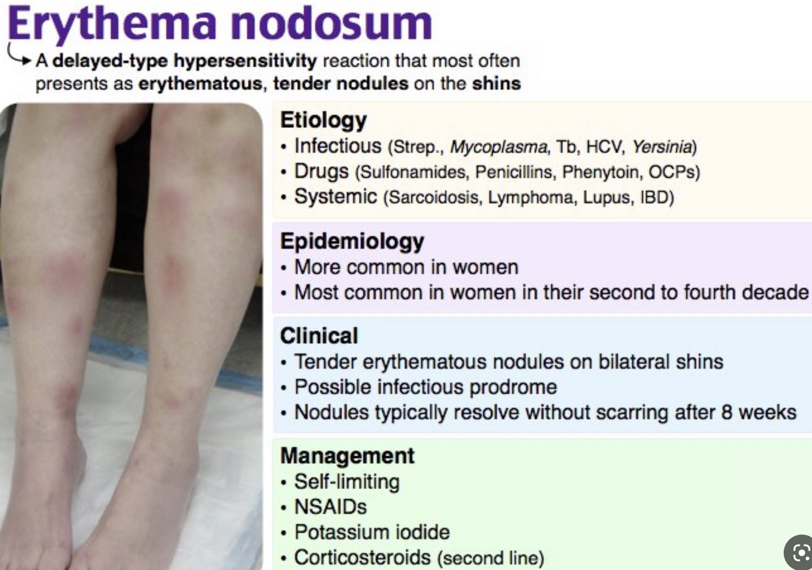 erythema nodosum