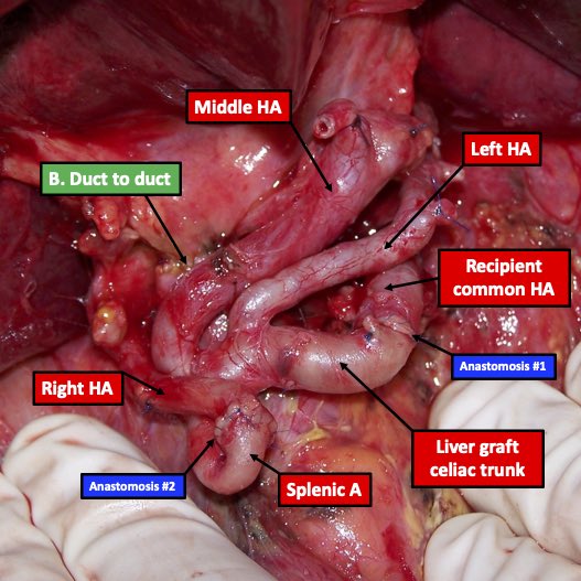 Multiple hepatic arteries in liver transplant…