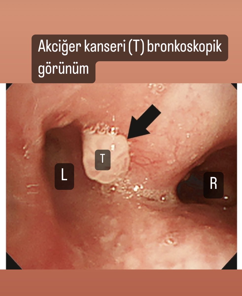 Akciğer kanserinin en önemli teşhis yöntemi bronkoskopi (solunum sisteminin endoskopisi). 
Resimde T akciğer kanseri, L sol ana bronş, R sağ ana bronş. 
#kanser #akciğerkanseri #akciğer #bronkoskopi #endoskopi #biopsi #biyopsi #teşhis #tedavi