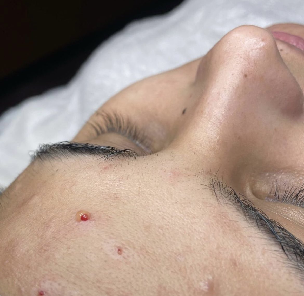 GLOSKINLAB's tweet image. #BeautyandBrains Volume lll: SEROUS FLUID 💧 First there is pus, blood, then this clear liquid called serous fluid. This is the skin’s message to me that the congested pore is now clear &amp;amp; this is when I would stop extracting.