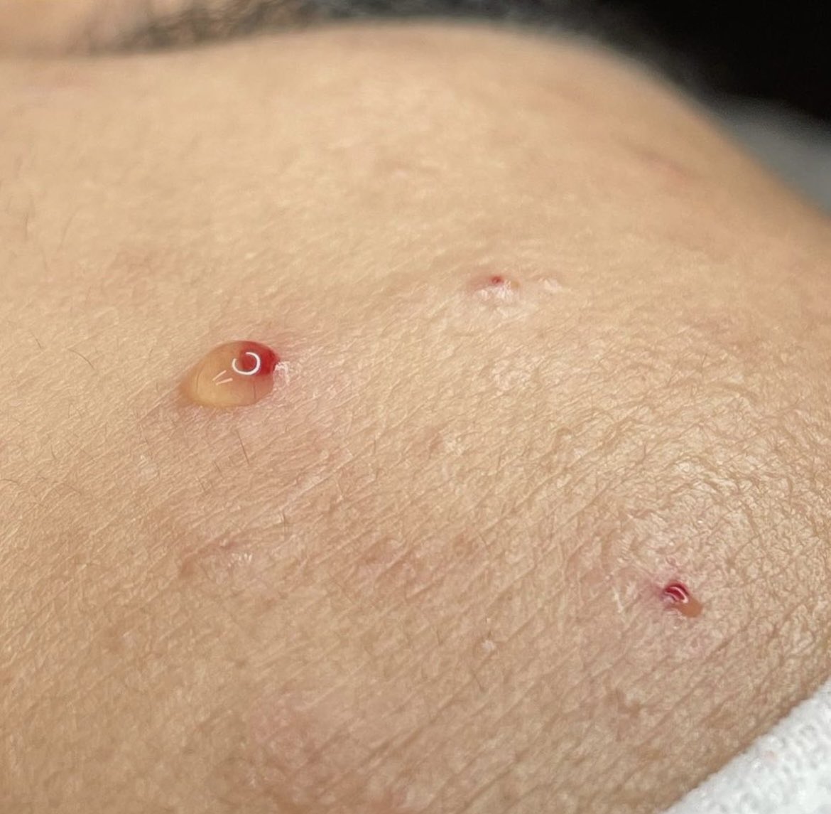 GLOSKINLAB's tweet image. #BeautyandBrains Volume lll: SEROUS FLUID 💧 First there is pus, blood, then this clear liquid called serous fluid. This is the skin’s message to me that the congested pore is now clear &amp;amp; this is when I would stop extracting.