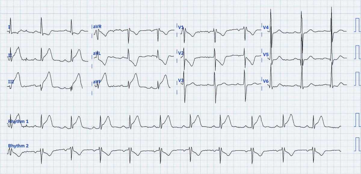 68M who came to the ER for epigastric pain, nausea, and sweating that started around 1 hour ago.
Dx? Culprit?

Courtesy of Clara Santos on LinkedIn—digitized using @PMcardioBot.

#CardioTwitter #MedEd #FOAMed
