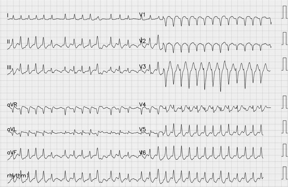 EcgOxford's tweet photo. Rhythm?
@MaruanCarlos @The_Nanashi_O @ShariqShamimMD @UlhasDr @DidlakeDW @ecgrhythms @syamkumarmd @DrRajeshG1 @DocNikko @AslangerE @Vadeboncoeur_Al @EF_Cardiaca @smithECGBlog @EM_RESUS @iamritu @DruvBhagavan @martinfd78 @estudiomedicina @OrlandoRPN #EPeeps #cardioed #FOAMcc https://t.co/XibG3iCW9P