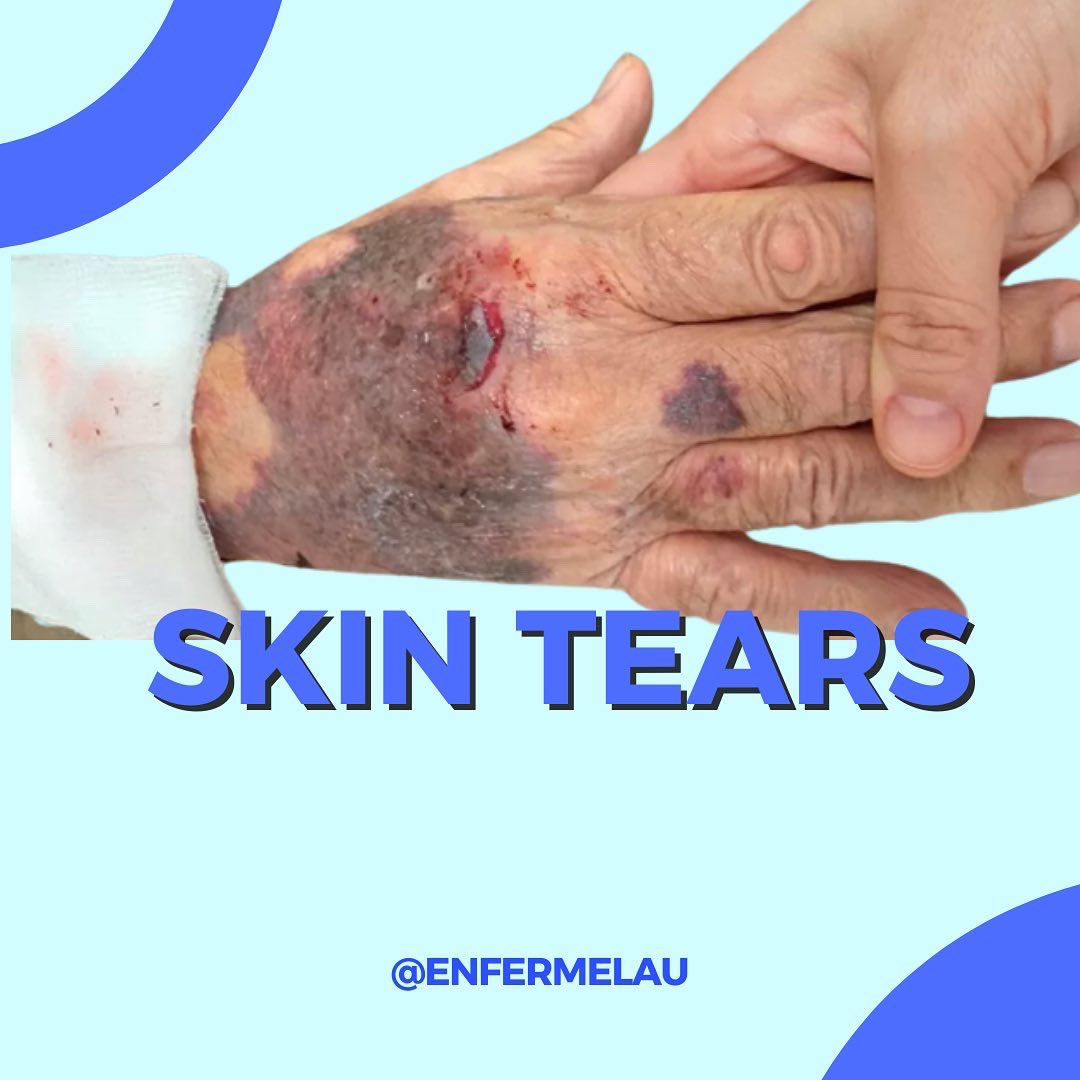 Por Instagram ya sabéis lo que es un skin tear y como por aquí también me seguís bastantes enfermeras, os dejo el post que he subido esta mañana a <a href="/enfermelau/">𝕷𝖆𝖚 🌸</a>. 
Toda la bibliografía está en el post. 

Dentro 🧵
