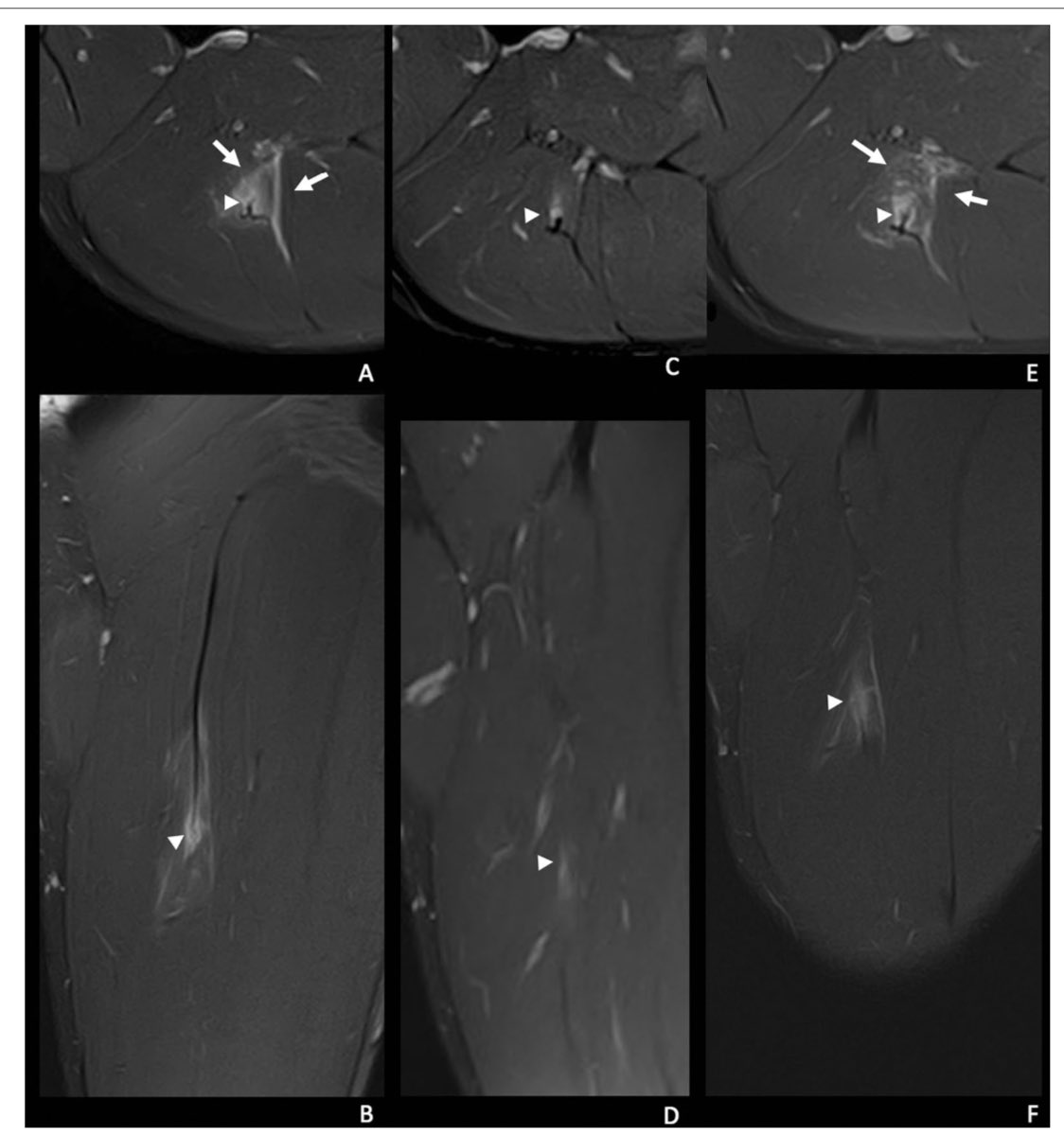 Jaime Isern Kebschull (@isernkebschull) on Twitter photo The new era in muscle injury management has arrived: MRI monitoring and re-injury prediction. Thanks to all the team! 💪🏻@ESR_Journals <a href="/MskSerme/">SERME</a> <a href="/myESR/">myesr</a> <a href="/hospitalclinic/">Hospital Clínic</a> <a href="/BarcaInnoHub/">Barça Innovation Hub</a> <a href="/ESSRmsk/">European Society of Musculoskeletal Radiology</a> The new era in muscle injury management has arrived: MRI monitoring and re-injury prediction. Thanks to all the team! 💪🏻@ESR_Journals <a href="/MskSerme/">SERME</a> <a href="/myESR/">myesr</a> <a href="/hospitalclinic/">Hospital Clínic</a> <a href="/BarcaInnoHub/">Barça Innovation Hub</a> <a href="/ESSRmsk/">European Society of Musculoskeletal Radiology</a>