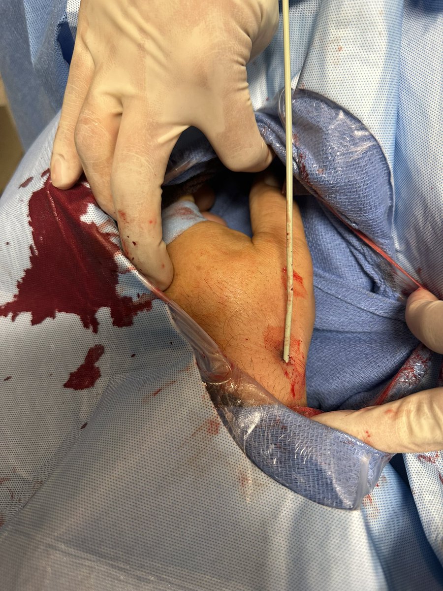 SuspectedLVO's tweet photo. Snuffbox access is a great tool in overweight patients, especially when left VA is the vessel of interest. Ruptured dissecting PICA aneurysm: Ballast, Sofia EX, PC 400 coils
#distalradial
#radialfirst
#aneurysm
#adventisthealth https://t.co/PR2upnOMcN