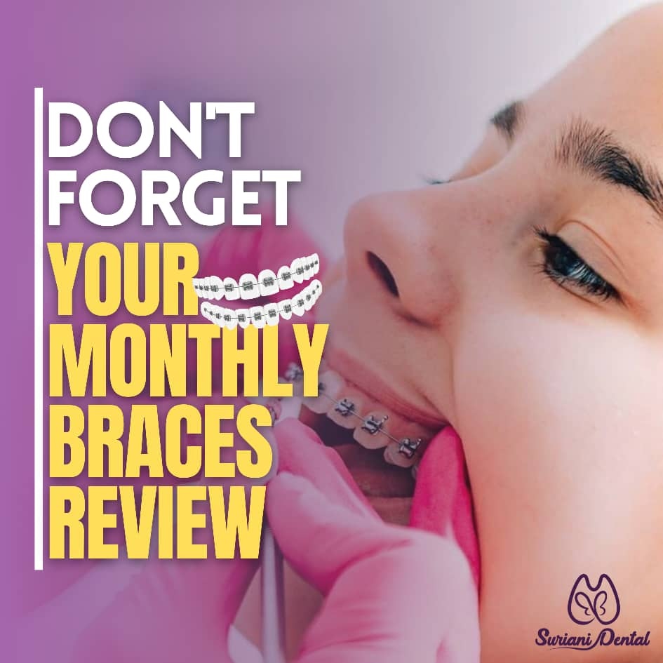 😍DONT FORGET TO COME AND VISIT FOR YOUR BRACES MONTHLY REVIEW😍

✨Enjoy your braces journey with us at SURIANI DENTAL🦷

OPEN EVERYDAY ✅

#love #surianidental #bracespromotion #lowdeposit #offer #kualalumpur #treats #panel #klinikpergigiansuriani #bestservice #qualityservice