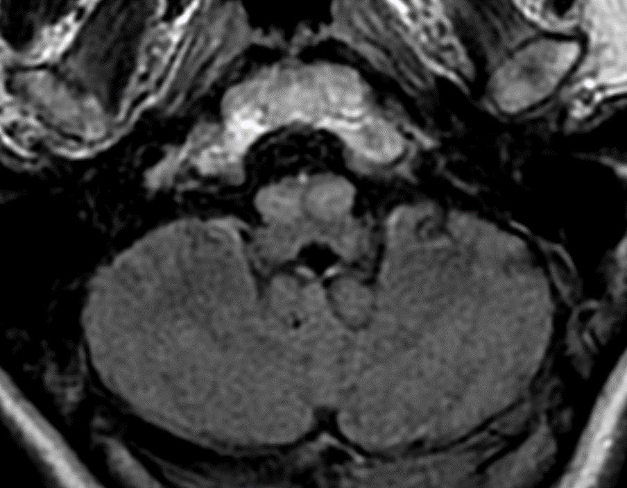 Daniel Gewolb, MD (@daniel_gewolb) on Twitter photo 73 y/o M presents with palatal myoclonus. MR shows hyperintense and enlarged inferior olivary nuclei.
#MedTwitter #radtwitter #radres #Neurology #Medstudent <a href="/ASNRographics/">Neurographics</a> 73 y/o M presents with palatal myoclonus. MR shows hyperintense and enlarged inferior olivary nuclei.
#MedTwitter #radtwitter #radres #Neurology #Medstudent <a href="/ASNRographics/">Neurographics</a>
