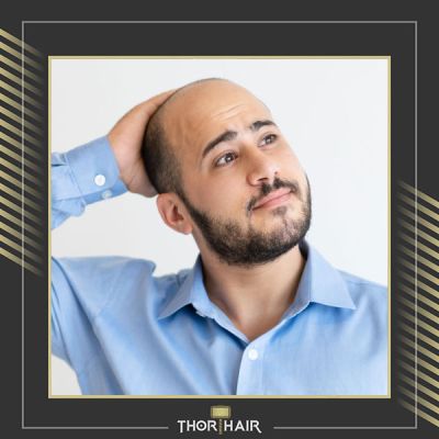 ThorHair's tweet photo. Which is the best hair transplant method? Why?

DHI is the most popular hair transplant method in Turkey. 

https://t.co/9msore0kq0

#Quora #besthairtransplantmethod #HairTransplants #Hairtransplantation #FUEhairtransplantinTurkey #ThorHairClinic #ThorHairTransplantClinic https://t.co/gHgHgEbqh7