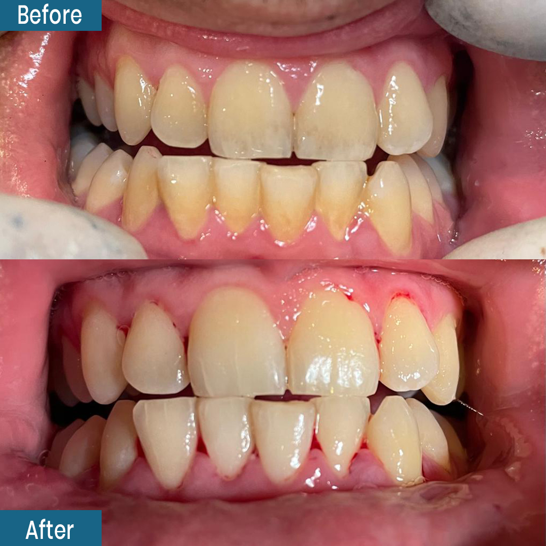 SmileCenterISB's tweet photo. Scaling &amp; polishing
Procedure done by Dr salwan Ghani

Smile center Dental Clinic,
Office 37&amp; 38 Ground floor, Al-babar Center, Park Road, F-8 Markaz Islamabad.

Book your appointment through Dm or Whatsapp or Call. 😊😊
☎051-8351111
📱03317779555
📍https://t.co/WeWXo7k2e8 https://t.co/PwQqHzq1Nu