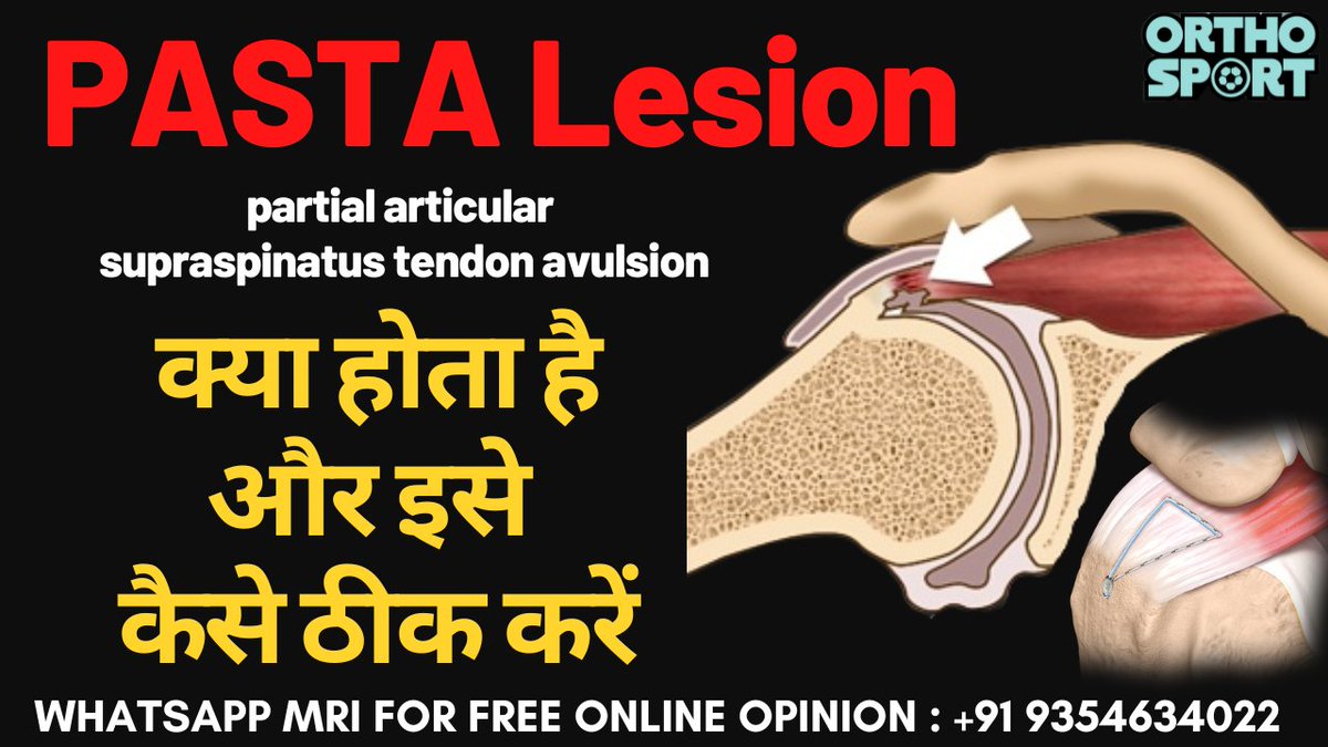 drmanubora's tweet photo. PASTA Lesion क्या होता है और इसे कैसे ठीक करें, Articular #Supraspinatus Tendon Avulsion Repair 
Checkout full video on YouTube- https://t.co/GHfa732np4 https://t.co/JkcSFnm6MO