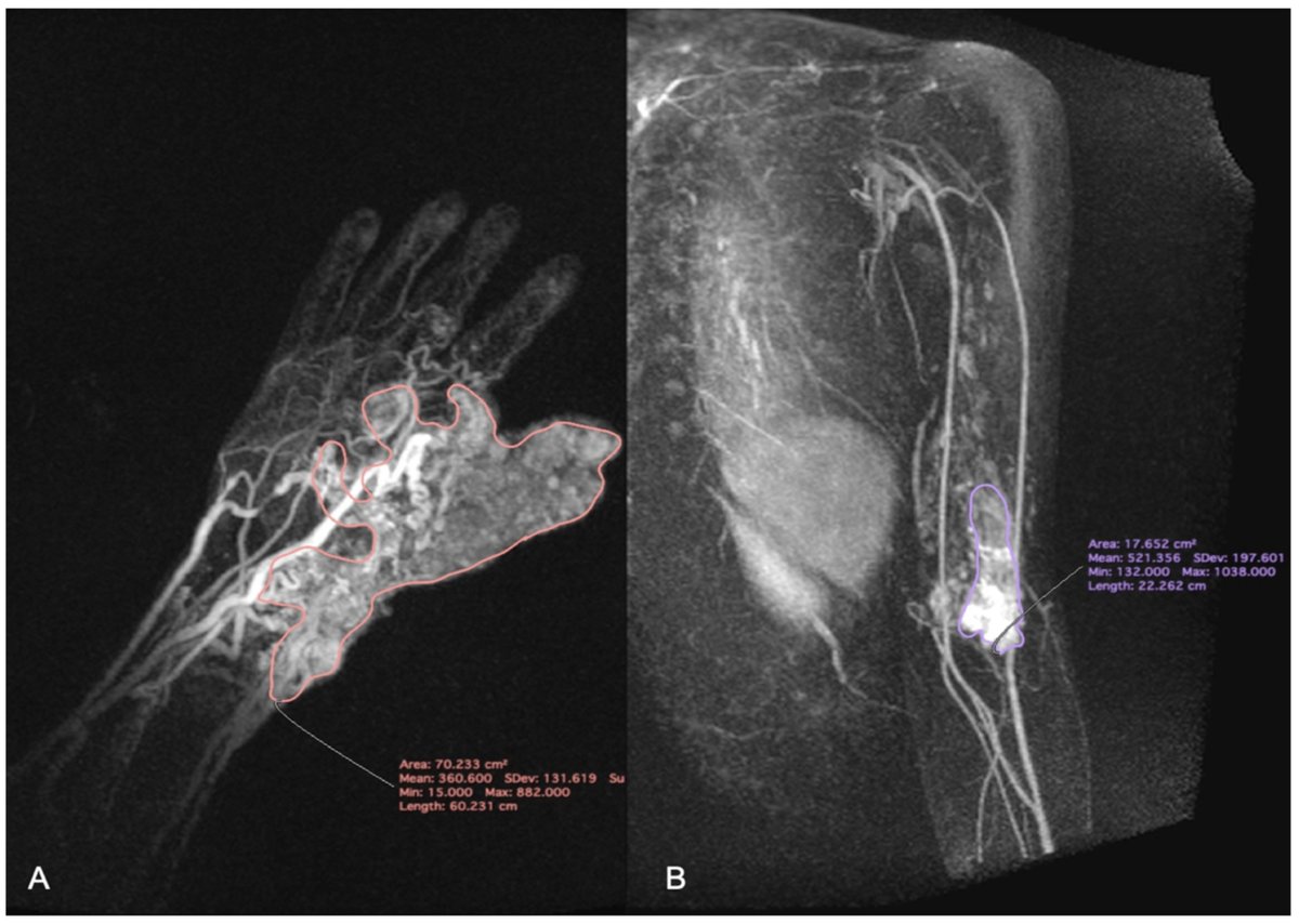 PUMS_tweets's tweet photo. "The Usefulness of #MRI Dynamic Flow Sequences in Differentiating High- and Low-Flow #Vascular Malformations" by #PUMS Majewska, Stański, et al. in @JCM_MDPI https://t.co/TIAc7BWj2v
#diagnostics #medicalimaging #HFVM #LFVM #DCEMRI #TWIST https://t.co/t25J5vATIO