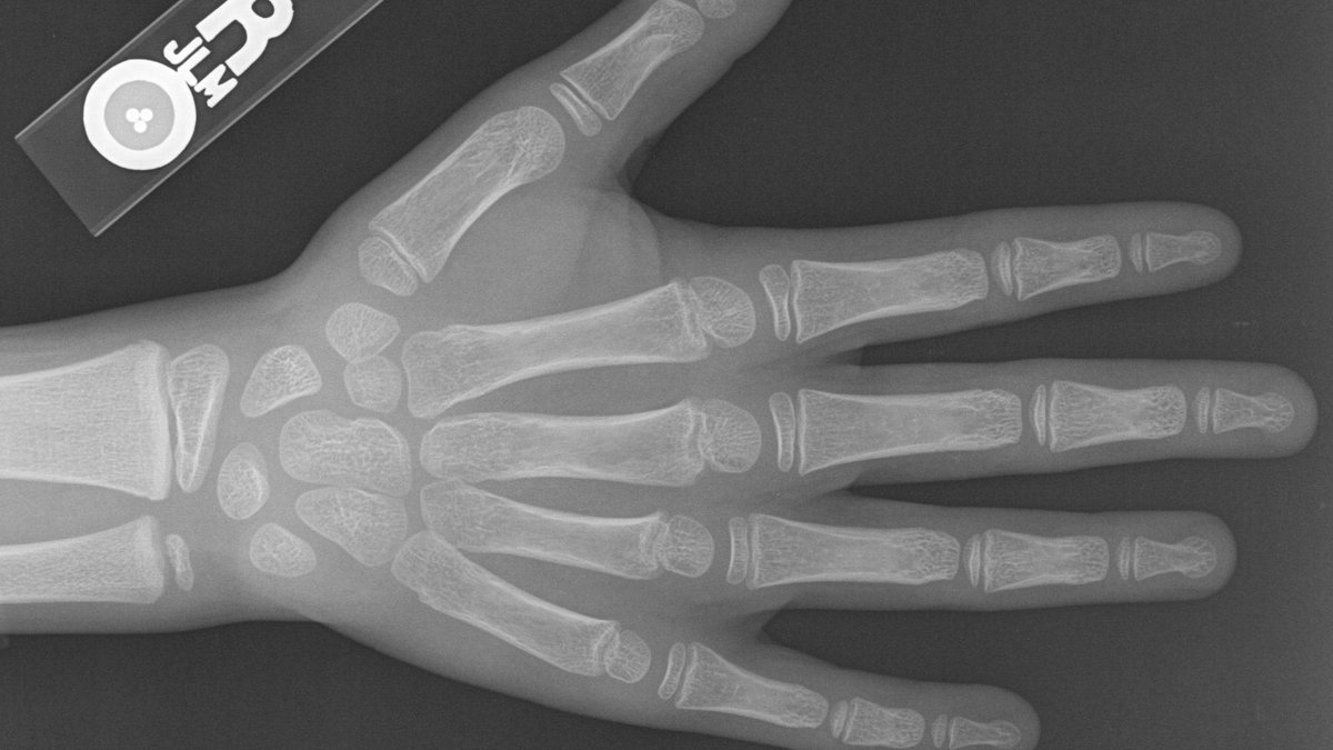 In a Christmas research special, Dr Susan Shelmerdine put an AI tool to the test in a part of the exams required to become a radiologist. It passed… but only just!

You can find out about the ‘grades’ in our article. gosh.nhs.uk/news/artificia…