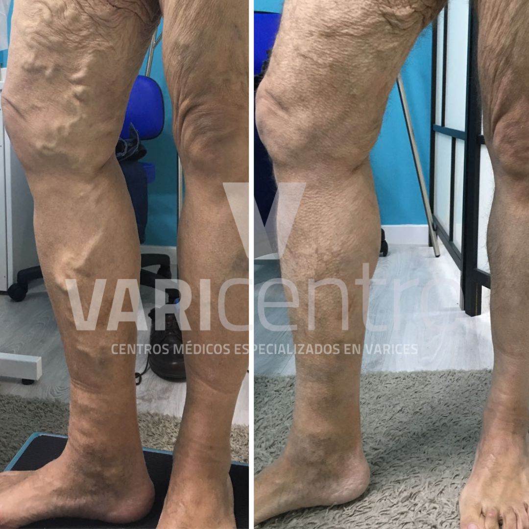 Varicentro's tweet photo. Una imagen vale más que mil palabras. Aquí os dejamos las fotos del antes y después del tratamiento con espuma esclerosante de un paciente.
Si quieres más información puedes contactar con nosotros en
☎️ 912 77 88 99 o en
🖥 https://t.co/gstaJ3A2qv
#Varicentro #varices https://t.co/7nyelBURVe