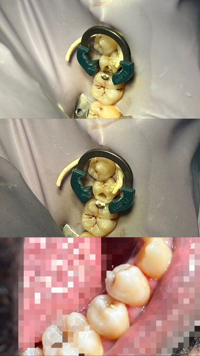 Class 2 restoration was done on tooth #29 
And perfect score has achieved 10/10 🦷🫶🏼🫡