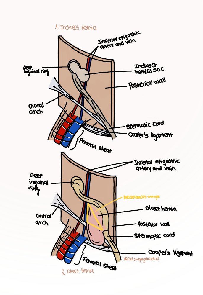 CiruAndes (@ciruandes2) on Twitter photo Marvelous surgical illustration to understand the difference between an indirect 🆚 direct groin hernia by Dr @isabellagaravism med student 👩🎓👩🏽⚕️future surgeon <a href="/futuroscirascol/">Future Surgeons</a> and academic coordinator of SICS! #SoMe4Surgery <a href="/pferrada1/">Paula Ferrada MD FACS FCCM MAMSE</a> <a href="/PipeCabreraV/">Dr Luis Felipe Cabrera Vargas MD FACS MACC MACCVA</a> <a href="/MISIRG1/">MISIRG</a> <a href="/juliomayol/">Julio Mayol</a> <a href="/SWexner/">Steven D Wexner MD, PhD</a> Marvelous surgical illustration to understand the difference between an indirect 🆚 direct groin hernia by Dr @isabellagaravism med student 👩🎓👩🏽⚕️future surgeon <a href="/futuroscirascol/">Future Surgeons</a> and academic coordinator of SICS! #SoMe4Surgery <a href="/pferrada1/">Paula Ferrada MD FACS FCCM MAMSE</a> <a href="/PipeCabreraV/">Dr Luis Felipe Cabrera Vargas MD FACS MACC MACCVA</a> <a href="/MISIRG1/">MISIRG</a> <a href="/juliomayol/">Julio Mayol</a> <a href="/SWexner/">Steven D Wexner MD, PhD</a>