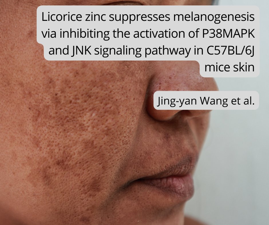 ActaCirurgicaBR's tweet photo. 🆕Study presents new evidence that licorice #zinc is a potential agent in the treatment of pigmentary #skin diseases, especially #chloasma.
🔓https://t.co/kJzaPQqdNM

#melanosis #MedTwitter #DermatoTwitter #openaccess https://t.co/BlH4WiXo17