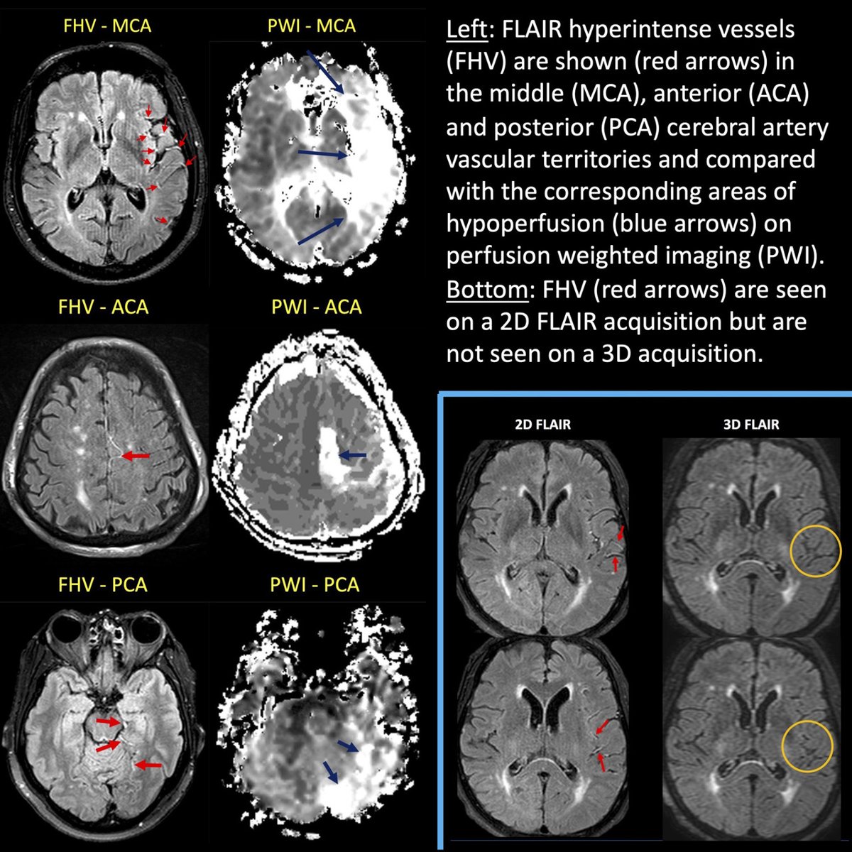 StrokeAHA_ASA's tweet photo. #OriginalResearch: The FLAIR hyperintense vessels are correlated with perfusion lesion volume and may help determine clinically relevant diffusion-perfusion mismatch, when combined with diffusion weighted imaging. https://t.co/ncWXLN2ow5 @DCStrokeDoc https://t.co/J81wZmlGpf