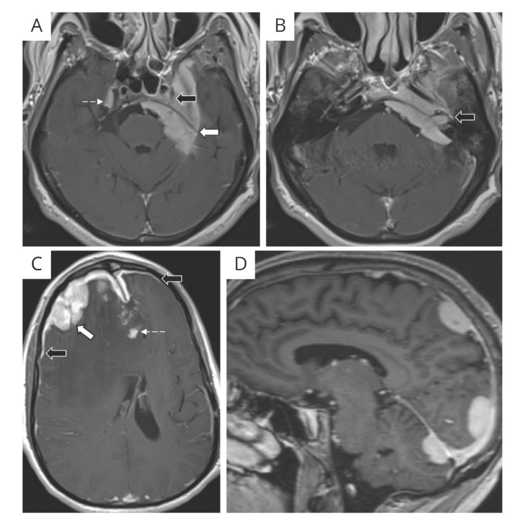 GreenJournal's tweet photo. Pachymeningitis in Biopsy-Proven Sarcoidosis: Clinical Course, Radiographic Findings, Response to Treatment, and Long-term Outcomes https://t.co/Y5rcZSVhEP

#Neurology #NeuroTwitter https://t.co/SarJkrfi48