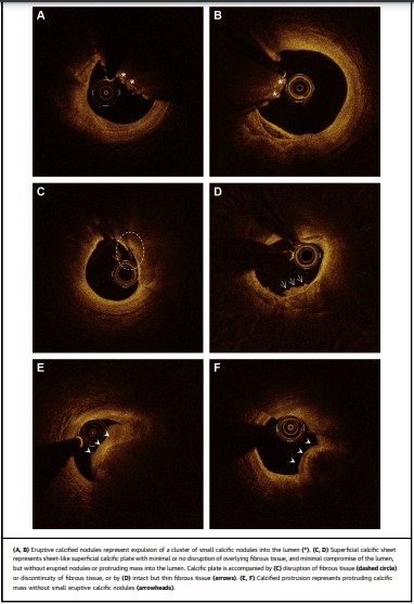 🔶Calcified Plaques in Patients/w ACS via @jaccjournals 

🔸3⃣ types of calcified plaques seen in ACS:  Superficial calcific sheets &gt; Eruptive nodules &gt;Calcified protrusion ( 67.4%. 25.5% &amp; 7.1%)
🔸Sup calcific sheets ➡️Highest Post PCI myocardial damage

jacc.org/doi/10.1016/j.…