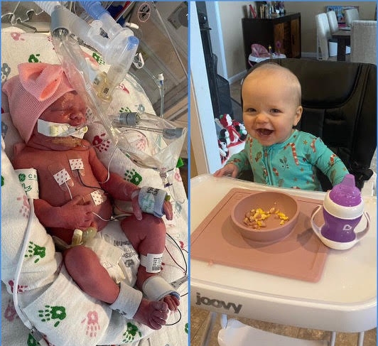 #WednesdayWarrior

What a difference a year makes.

Emma Grace recently celebrated her first birthday. Happy belated birthday Emma. ❤️

For ways to make an impact through JCF and support babies like Emma, visit jacksonchance.org