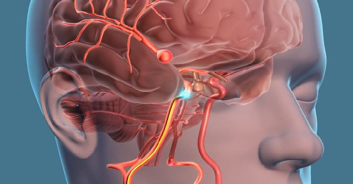 blogdokter's tweet photo. Salah satu penyebab perdarahan otak yang tidak ada gejala khas sebelumnya adalah pecahnya aneurisma otak.

Aneurisma otak adalah tonjolan berbentuk balon yang terbentuk di pembuluh darah otak.

Sebelum pecah, aneurisma otak hampir tidak memiliki gejala yang khas. https://t.co/l7gU7GC5R3