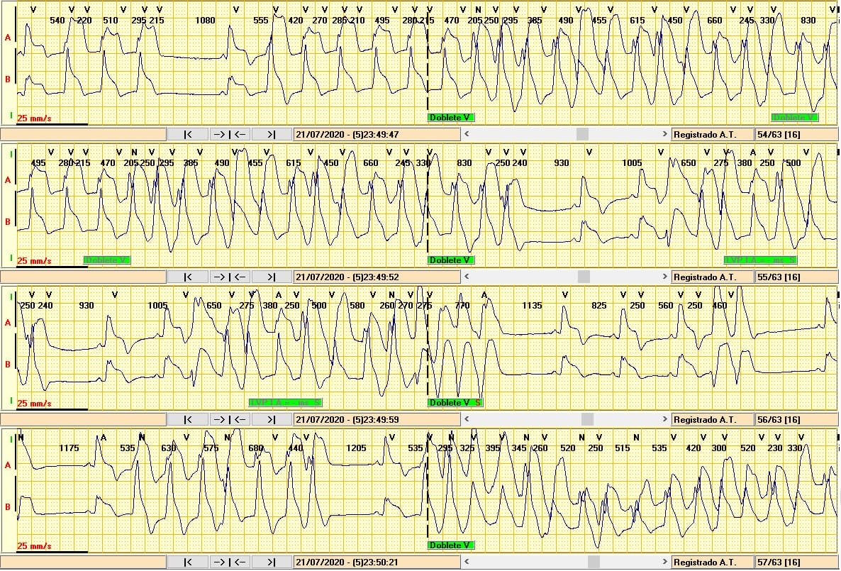 Albamariag2's tweet photo. @clinica_sec Varón 56 años con angina recurrente de 3-5 min. En holter de eventos se objetiva ascenso ST + TV polimórficas autolimitadas con la clínica.

💡El Kardia o holter de eventos pueden ser útiles para diagnosticar angina vasoespástica https://t.co/Ie0tHWVNIS