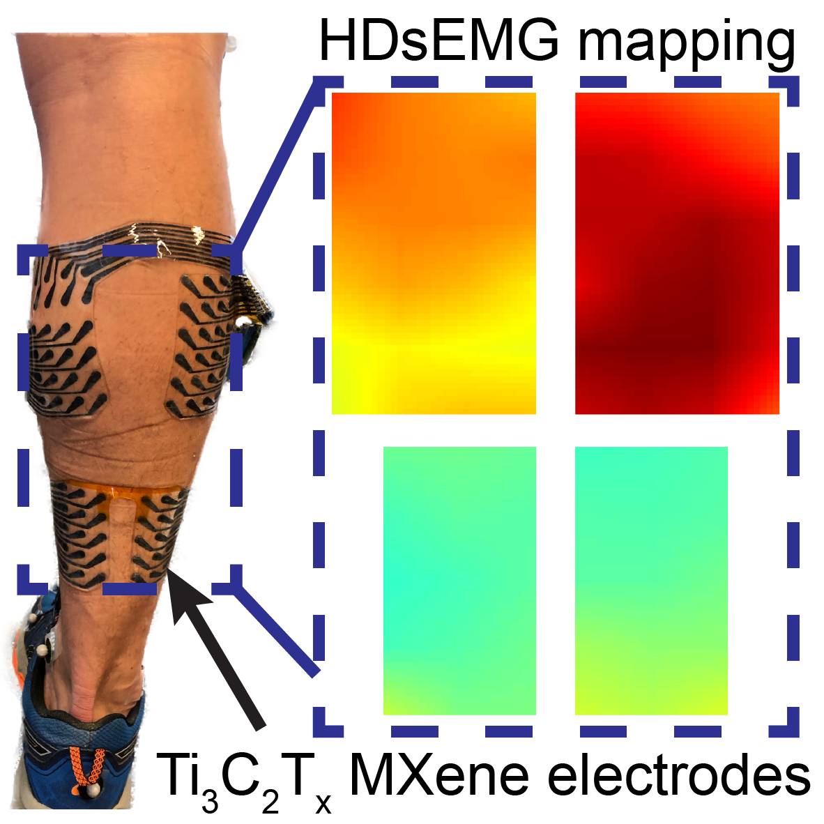 Excited to end 2022 by sharing our recent work on wearable high-density MXene bioelectronics for #NeuromuscularDiagnostics, #Rehabilitation, and #AssistiveTechnologies! 

doi.org/10.1002/smtd.2…