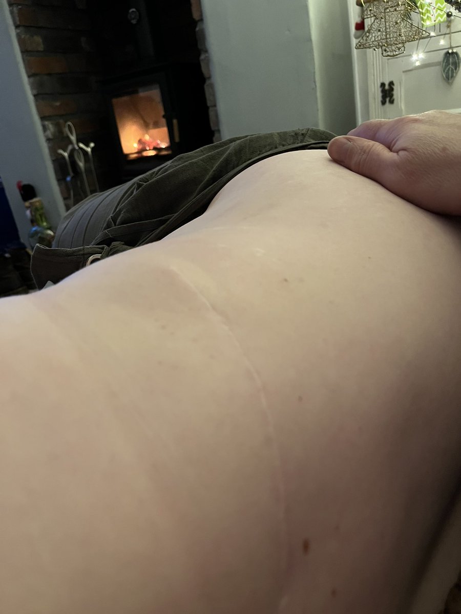 My wife battles every day with pain following cancer treatment and a LFD reconstruction 10 years ago, so proud of her and continue to celebrate her scars as proof of life continuing. She hates them, they do not define her, her life does  🥰
