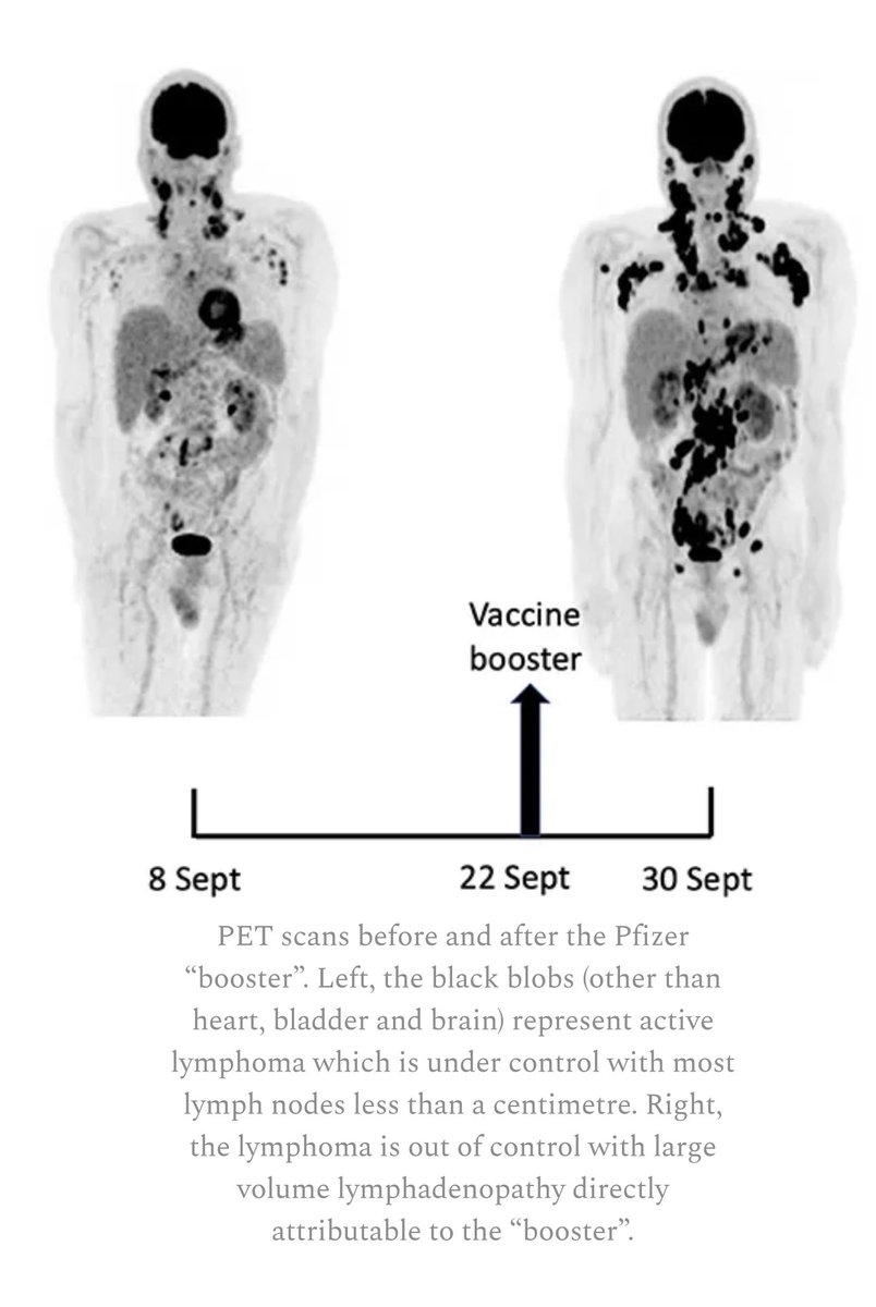 JoshWalkos's tweet photo. This is an image of a PET scan before and after the Pfizer covid booster. This person had lymphoma but it was under control prior but after look at the explosion in tumors just 8 days after.  #StoptheShotsNow #COVID19 #VaccineDeaths https://t.co/93lGYI8VcV