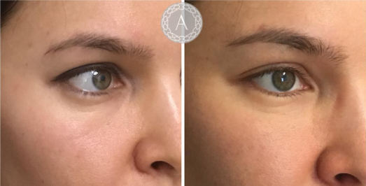 AestheticsAvika's tweet photo. Worried about lines under your #eyes? Here, we have used 1ml #Juvederm Volbella to reduce the appearance of under-eye hollowing. Very subtle, yet very effective 👏
#aesthetics #beauty #fillers #fillerslondon #teartroughfillers #vycross #tiredeyes #harleystreet #marylebone https://t.co/hdmHFP3ci5