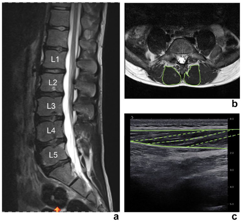 Sports_Health's tweet photo. Read it #OnlineFirst Lumbar Multifidus Morphology in Youth Competitive Alpine Skiers and Associated Sex, Age, Biological Maturation, Trunk Stability, and Back Complaints https://t.co/y4OYnyId1l https://t.co/x7X2Ga5Fhx