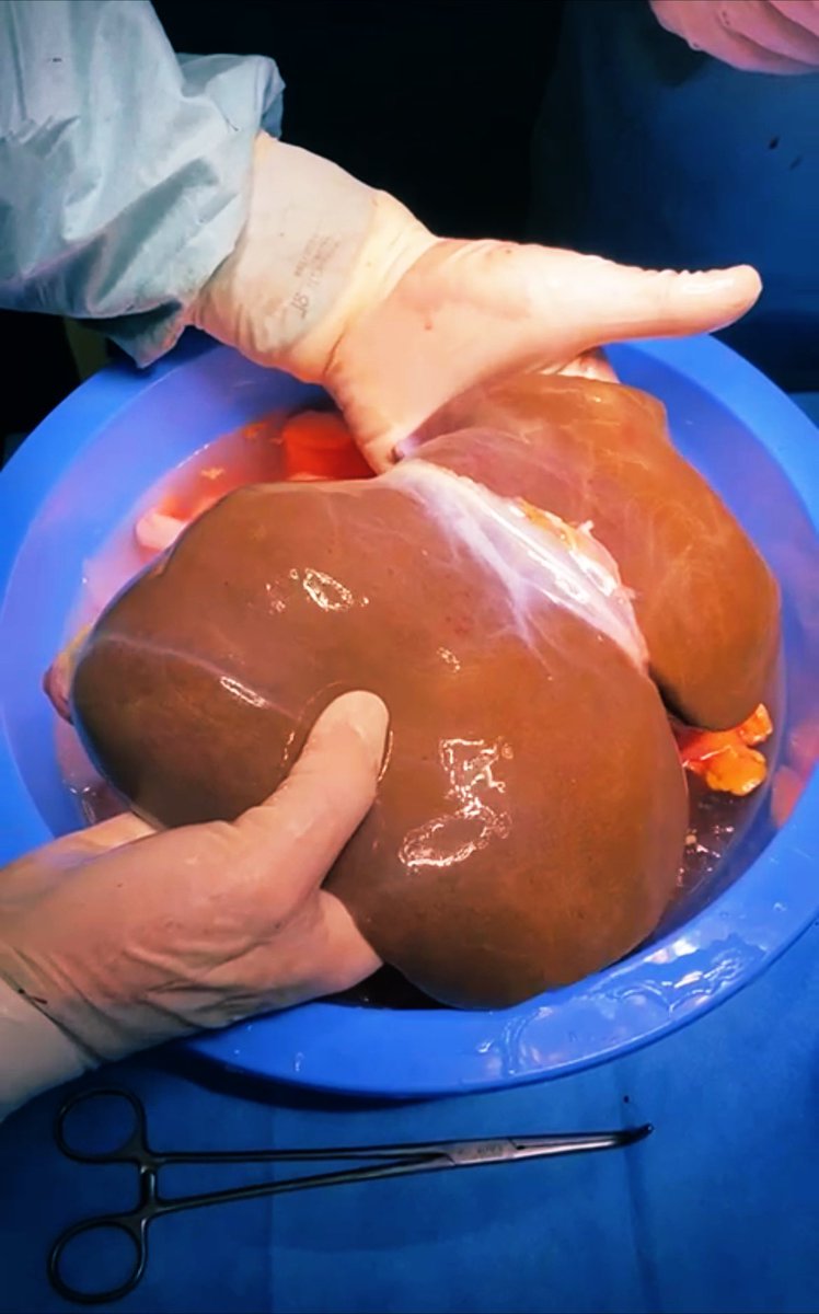 DeCarlis_R's tweet photo. We have just received and transplanted in Milan a #DCD #liver from the Netherlands. An about 1,000 km trip!✈️ Great collaboration! Thank you to the donor and all the colleagues involved! @Leo_100nze @Sa92_10 @_LucaCigagna_ #livertwitter #transplant #machineperfusion https://t.co/TvswIxmDeo