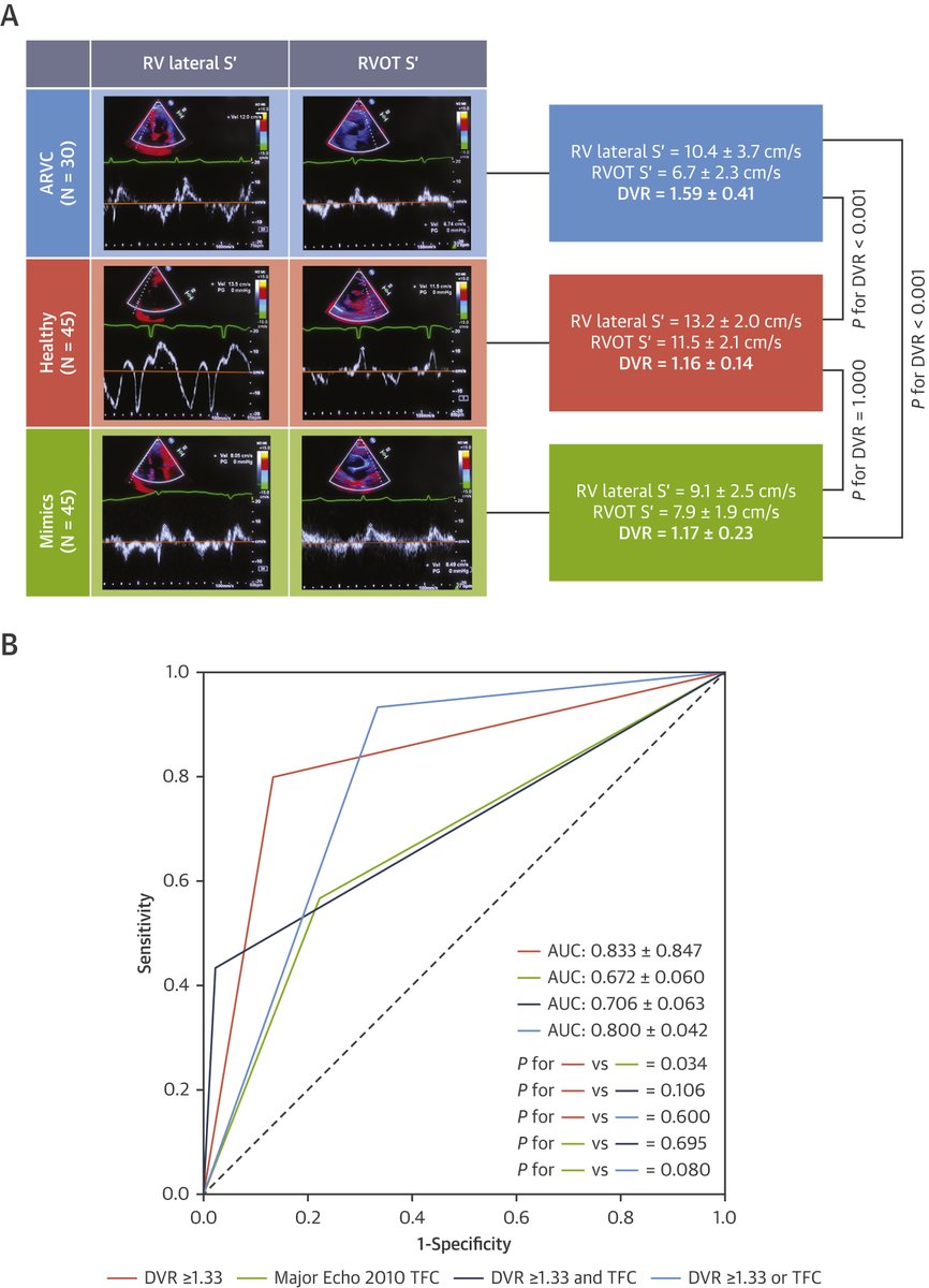 Novel simple #EchoFirst marker of RV arrhythmogenic cardiomyopathy? Doppler velocity ratio defined as the ratio of RV free wall: RVOT S’ (by tissue doppler) was found to have high accuracy for ARVC diagnosis (AUC 0.83). bit.ly/3YiBfS7

#JACCIMG #cvImaging #CardioTwitter