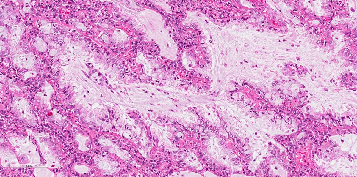 smlungpathguy's tweet photo. ALK-positive lung adenocarcinoma: The immunostain is ultrasensitive ALK (D5F3) https://t.co/nOgOLoo1tM https://t.co/OR6WkLw2Gm