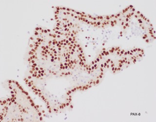 SunyUpstate's tweet photo. Positive IHC includes CK7, PAX-8, and AMACR. The diagnosis is Papillary Renal Cell Carcinoma. Thanks to all those who participated! https://t.co/lFGzTxx1Lb