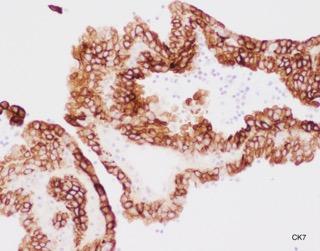 SunyUpstate's tweet photo. Positive IHC includes CK7, PAX-8, and AMACR. The diagnosis is Papillary Renal Cell Carcinoma. Thanks to all those who participated! https://t.co/lFGzTxx1Lb