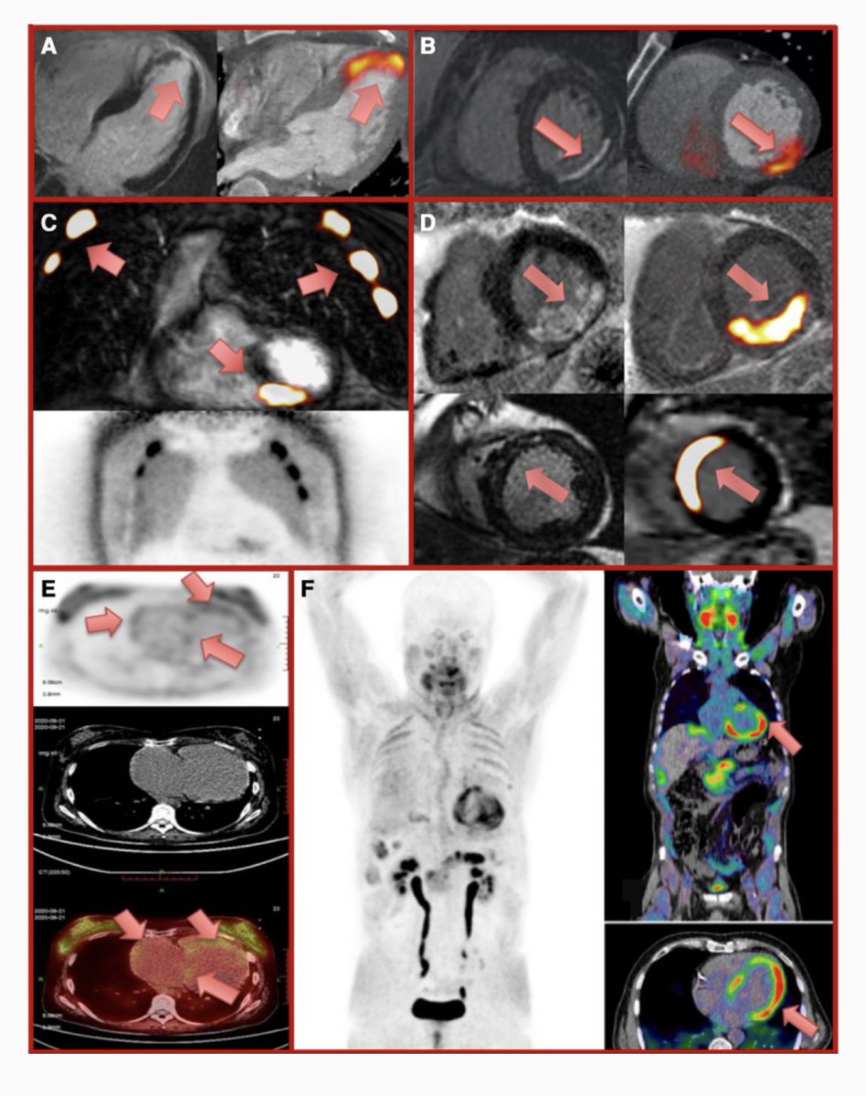 Pleased to present our review article discussing the present and future of molecular myocardial fibrosis imaging. Interested to learn now novel PET tracers may change the field? Read on to learn more 👓 📚 

#whyCMR #multimodalityimaging #cardiotwitter

doi.org/10.1093/ehjci/…