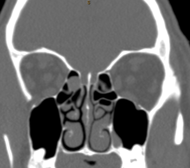 DrScottFortune's tweet photo. Is it a #mucocele or maybe an #encephlocele review the #Imaging and you decide. The pt. does have symptoms, so please remark on your treatment plan #SinusCTscan #MRIorbits #Rhinology #MedEd #MedTwitter Closing out #Rhinology2022 with this post https://t.co/n1qYQTYFIp