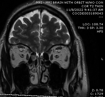 DrScottFortune's tweet photo. Is it a #mucocele or maybe an #encephlocele review the #Imaging and you decide. The pt. does have symptoms, so please remark on your treatment plan #SinusCTscan #MRIorbits #Rhinology #MedEd #MedTwitter Closing out #Rhinology2022 with this post https://t.co/n1qYQTYFIp