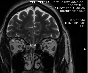 DrScottFortune's tweet photo. Is it a #mucocele or maybe an #encephlocele review the #Imaging and you decide. The pt. does have symptoms, so please remark on your treatment plan #SinusCTscan #MRIorbits #Rhinology #MedEd #MedTwitter Closing out #Rhinology2022 with this post https://t.co/n1qYQTYFIp