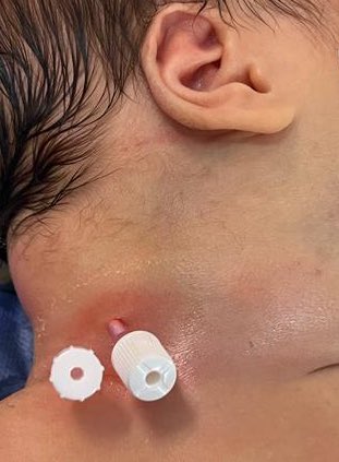 Dtepl's tweet photo. Today's case: prenatal MRI and postnatal #sclerotherapy of cervical #lymphaticmalformation with Doxycycline, endoscopy evaluation of the airway in the same procedure showed no airway compromise so, no tracheostomy for now. #vascularmalformations https://t.co/uc3cIytfz1