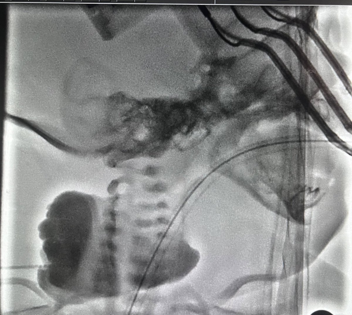 Dtepl's tweet photo. Today's case: prenatal MRI and postnatal #sclerotherapy of cervical #lymphaticmalformation with Doxycycline, endoscopy evaluation of the airway in the same procedure showed no airway compromise so, no tracheostomy for now. #vascularmalformations https://t.co/uc3cIytfz1